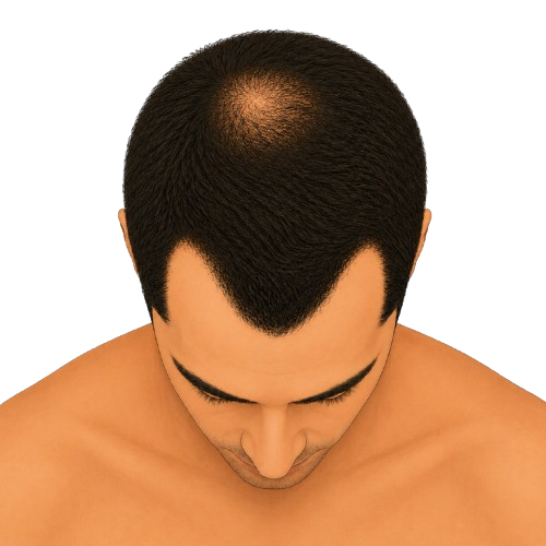 Stage 3 Vertex - top view