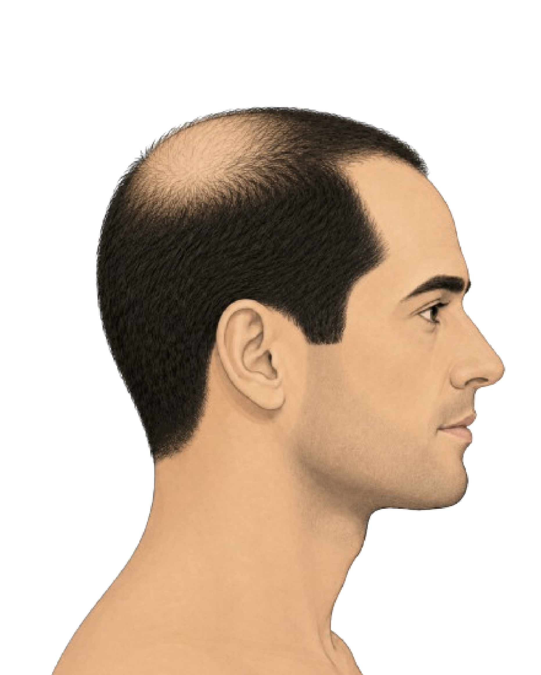 Stage 4