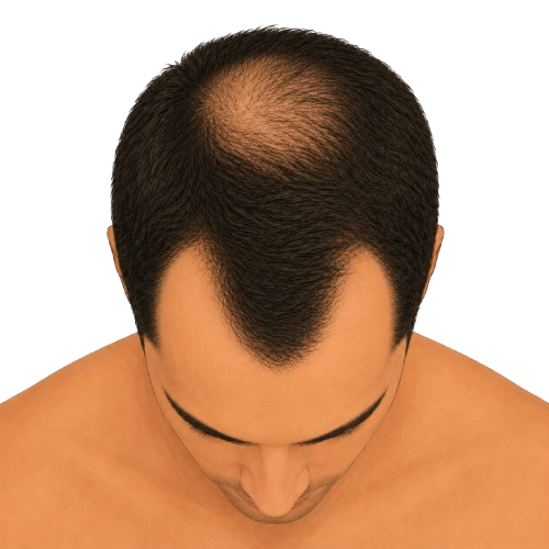 Stage 4 - top view