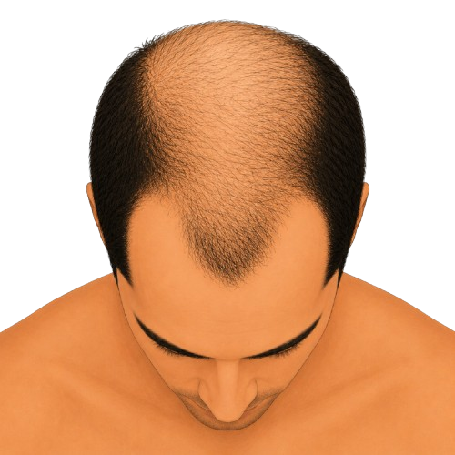 Stage 5 - top view